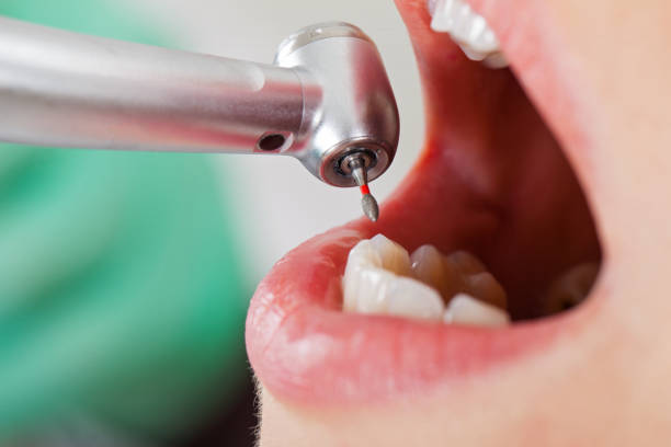 Best Chipped Tooth Repair Near Me  in Lynchburg, MS